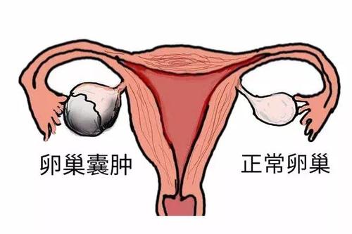 毕节妇女卵巢囊肿破裂是什么原因
